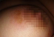 治疗乳房周围缠腰火丹(带状疱疹)疾病一则-缙哥哥