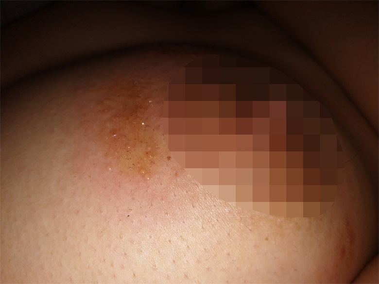 7月27日就诊是乳头上方的密集水泡，确诊为缠腰火丹（带状疱疹）。